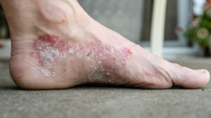 پسوریازیس(Psoriasis) چیست؟
