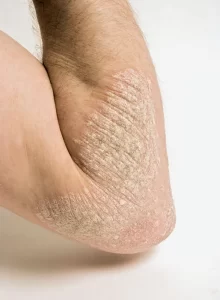 پسوریازیس(Psoriasis) چیست؟