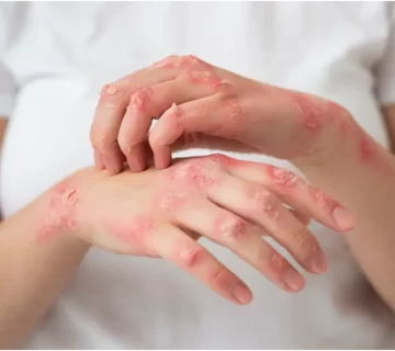 هر آنچه که باید در مورد گال بدانید