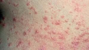 پسوریازیس(Psoriasis) چیست؟