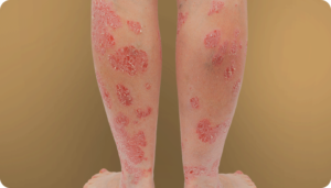 پسوریازیس(Psoriasis) چیست؟