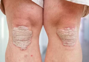 پسوریازیس(Psoriasis) چیست؟