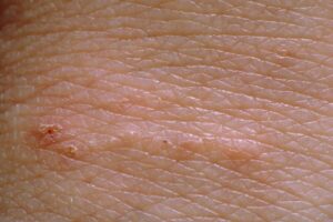 گال(Scabies)!!!