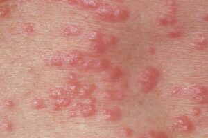 گال(Scabies)!!!