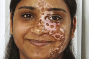 ویتیلیگو (vitiligo) بیماری لک و پیس