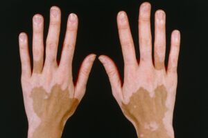 ویتیلیگو (vitiligo) بیماری لک و پیس