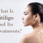 ویتیلیگو (vitiligo) بیماری لک و پیس