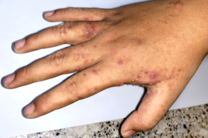 گال(Scabies)!!!