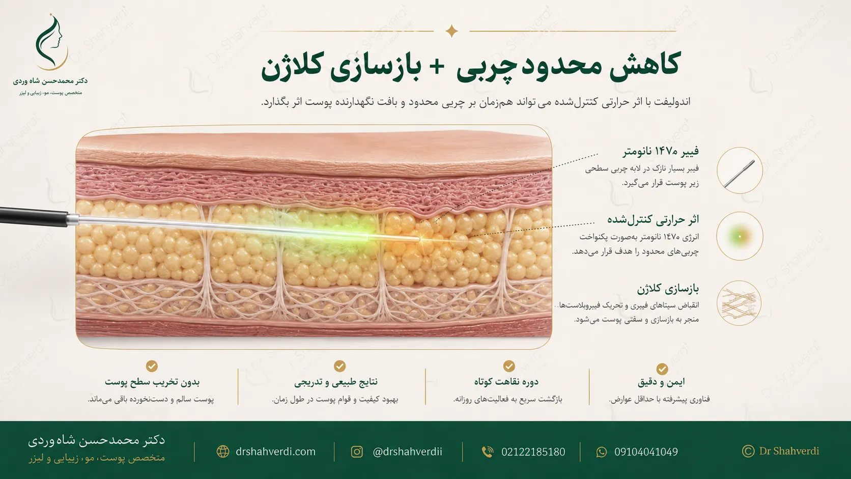 نحوه اثر فیبر لیزر ۱۴۷۰ نانومتر اندولیفت بر چربی و کلاژن