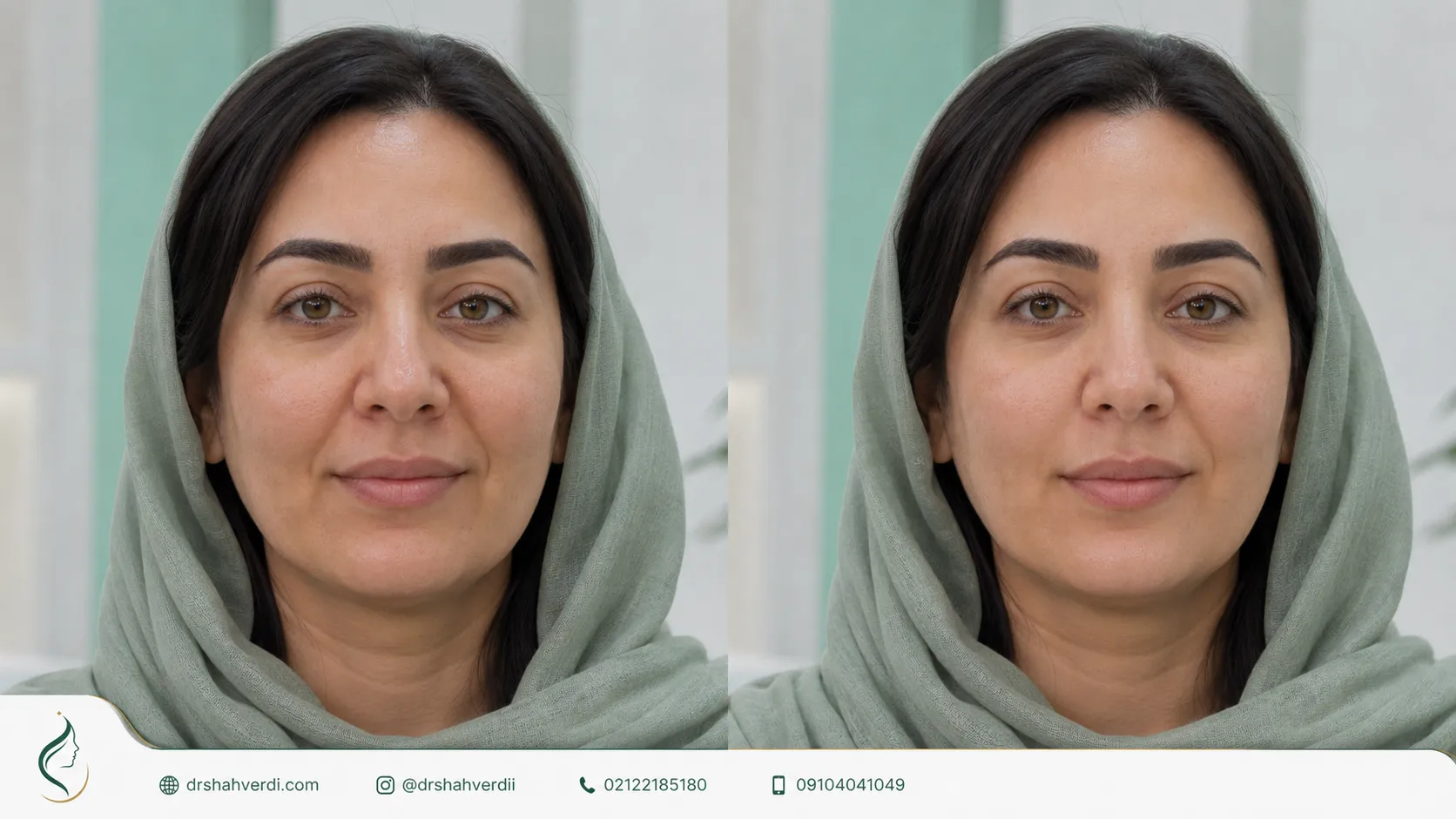 نحوه اثر اندولیفت در بینی گوشتی و پرحجم با انتقال کنترل‌شده انرژی
