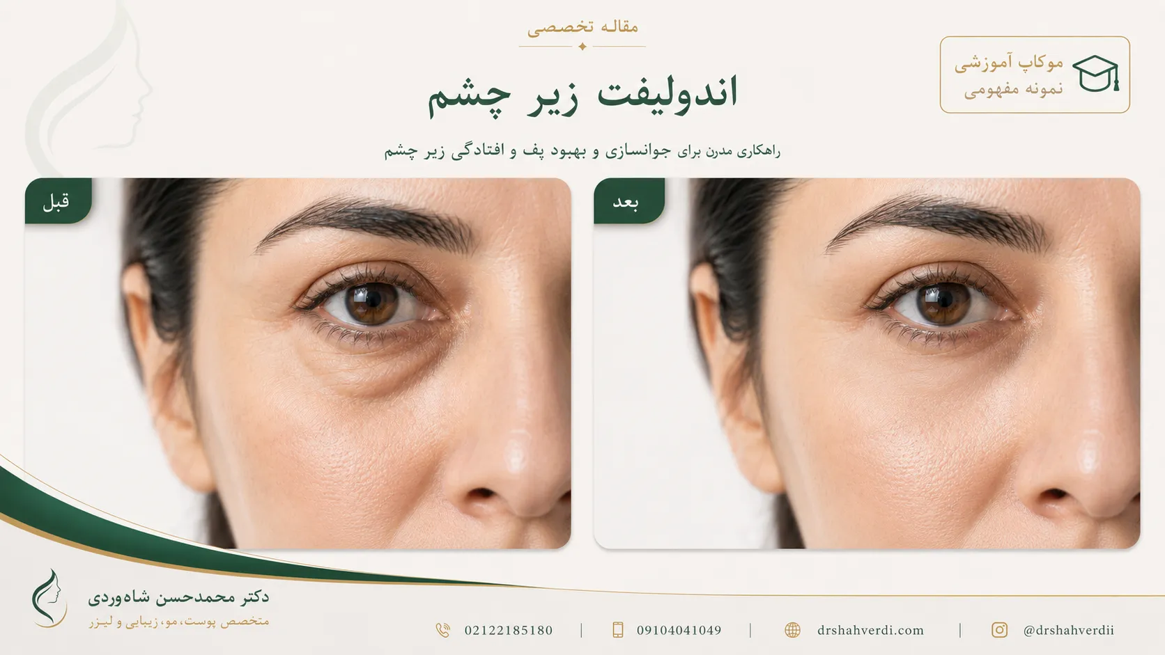 قبل و بعد طبیعی اندولیفت زیر چشم با کاهش پف و حفظ فرم طبیعی چشم