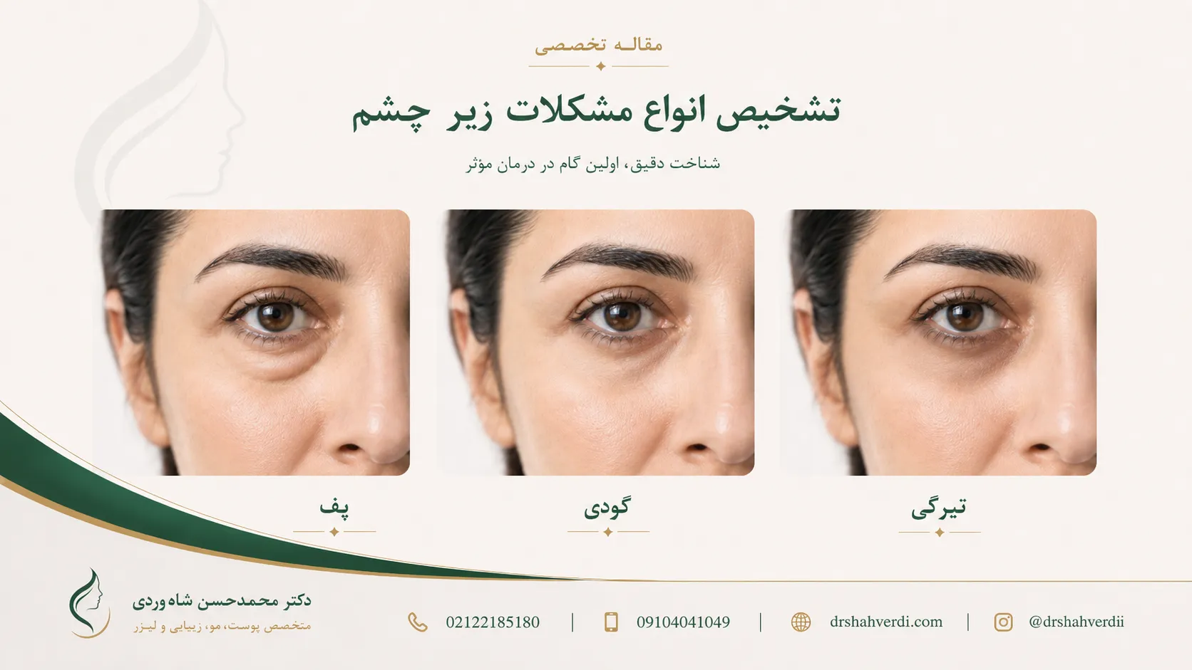 تفاوت انواع پف زیر چشم با گودی تیرگی ادم و فستون