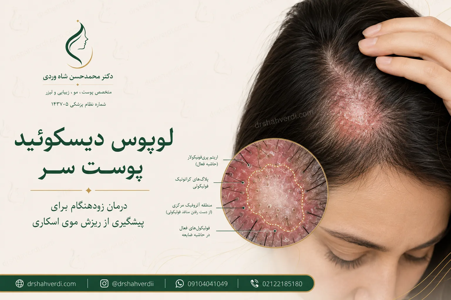 لوپوس دیسکوئید پوست سر و خطر ریزش موی اسکاری دائمی