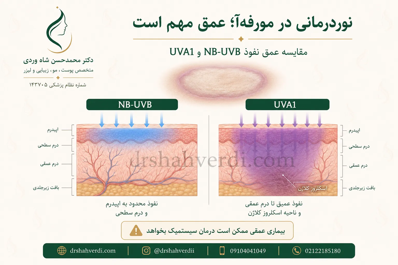 مورفه‌آ و نقش عمق نفوذ UVA1