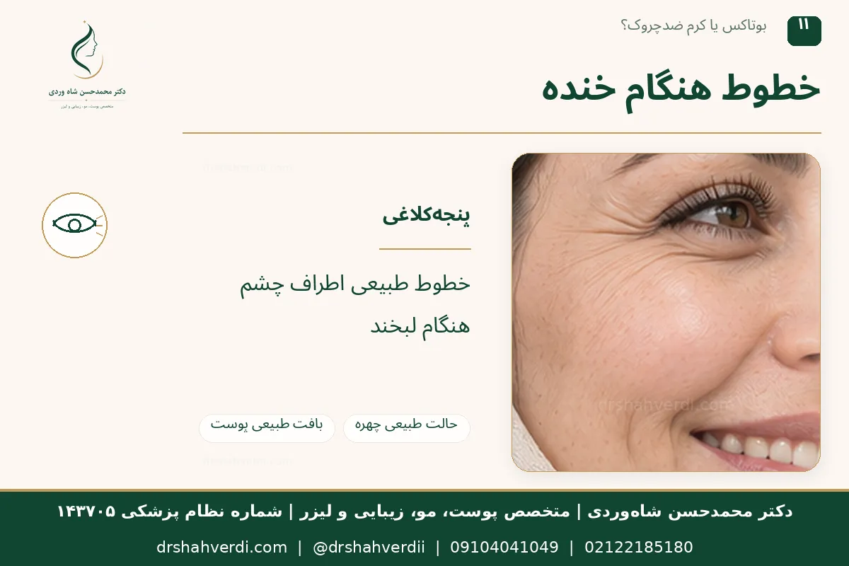 خطوط کنار چشم هنگام خنده