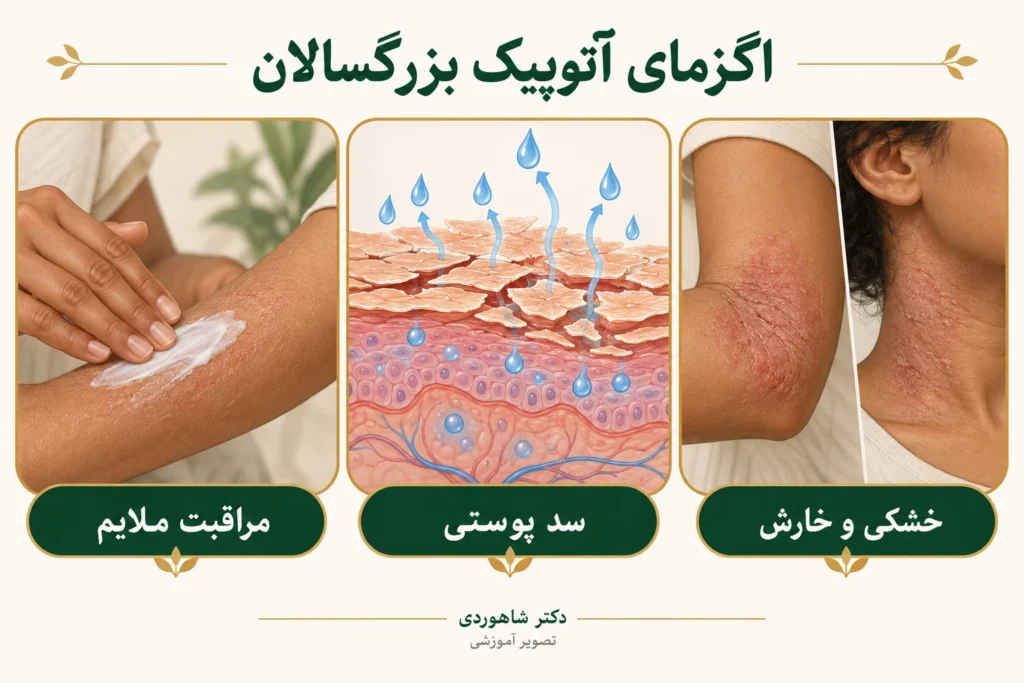 تصویر مقاله درماتیت آتوپیک بزرگسالان؛ درمان، کنترل عود و مراقبت روزانه