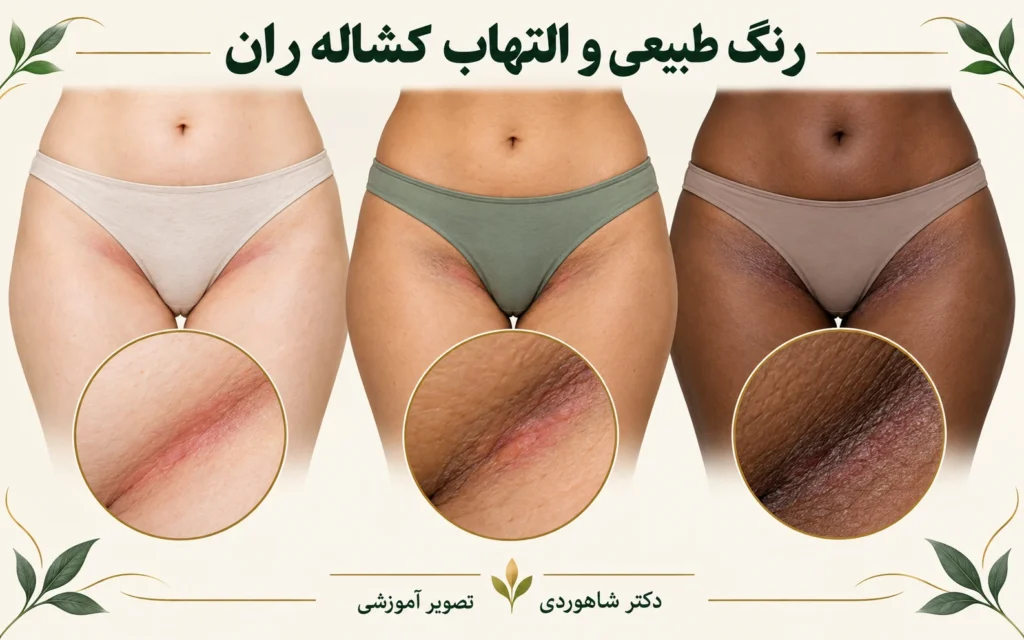تصویر مقاله تیرگی کشاله ران و بیکینی؛ رنگ طبیعی یا نشانه التهاب؟