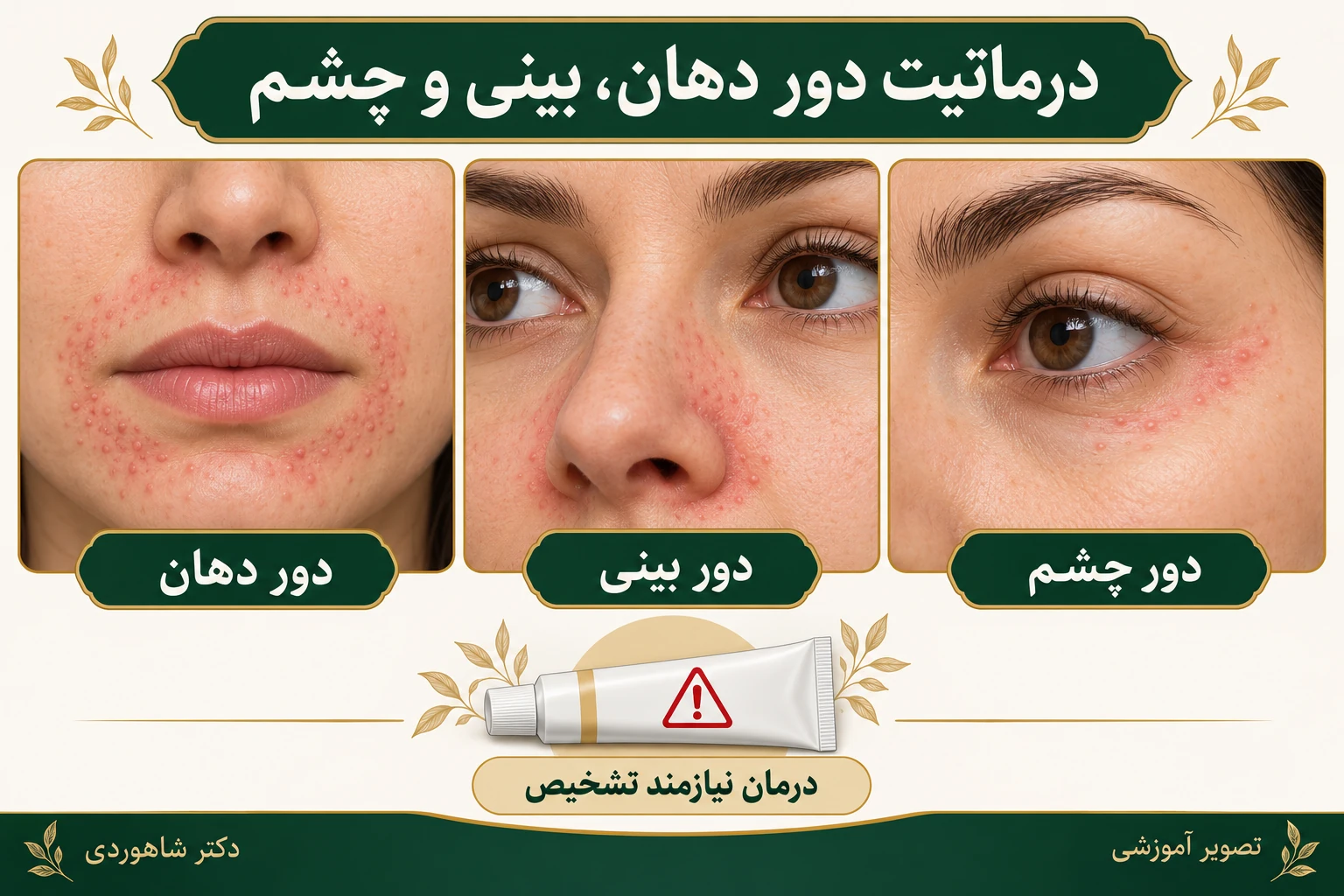 چهره با دانههای ریز اطراف دهان و کنار بینی، با حفظ نوار باریک کنار لب