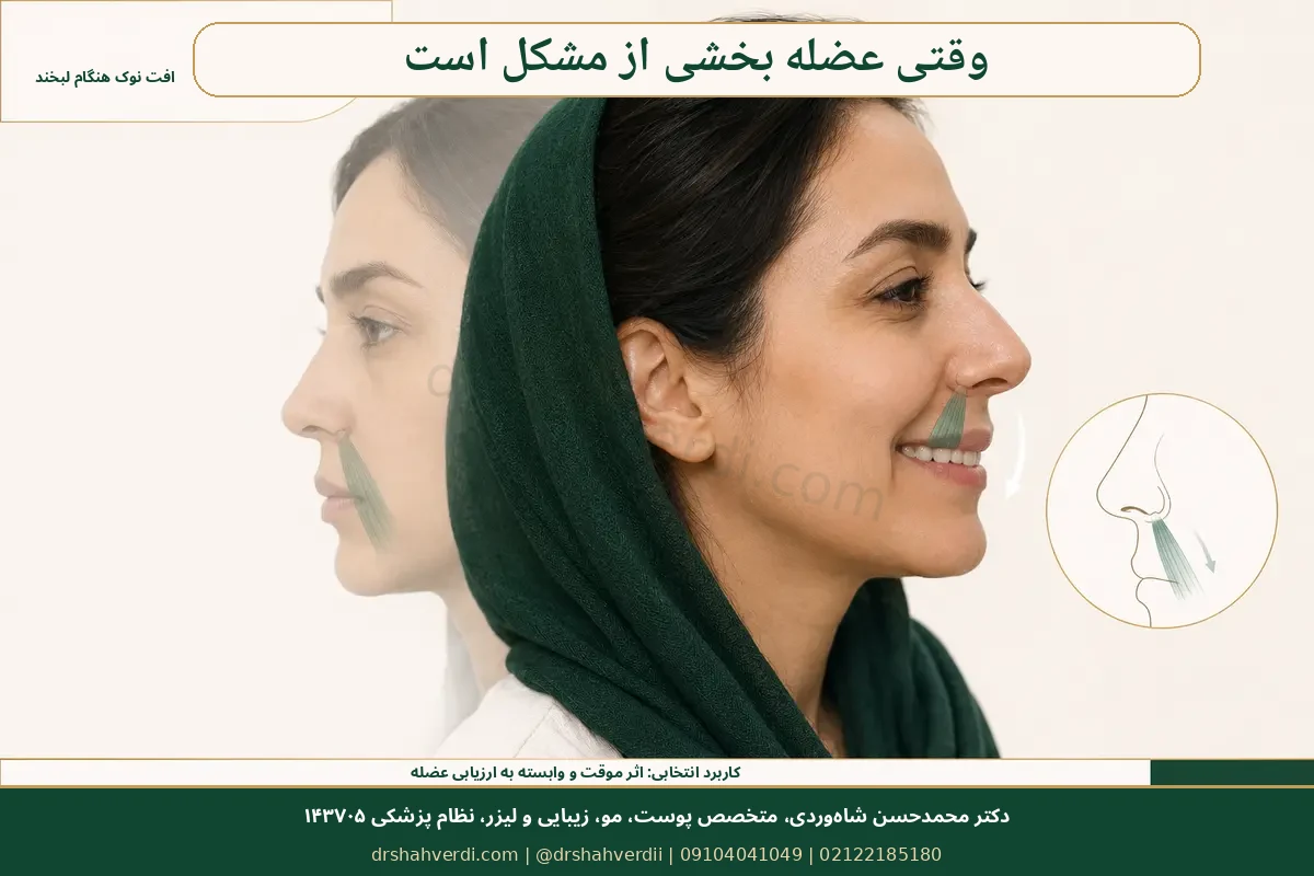 مفهوم افتادگی پویا نوک بینی هنگام خنده و نقش محدود بوتولینوم