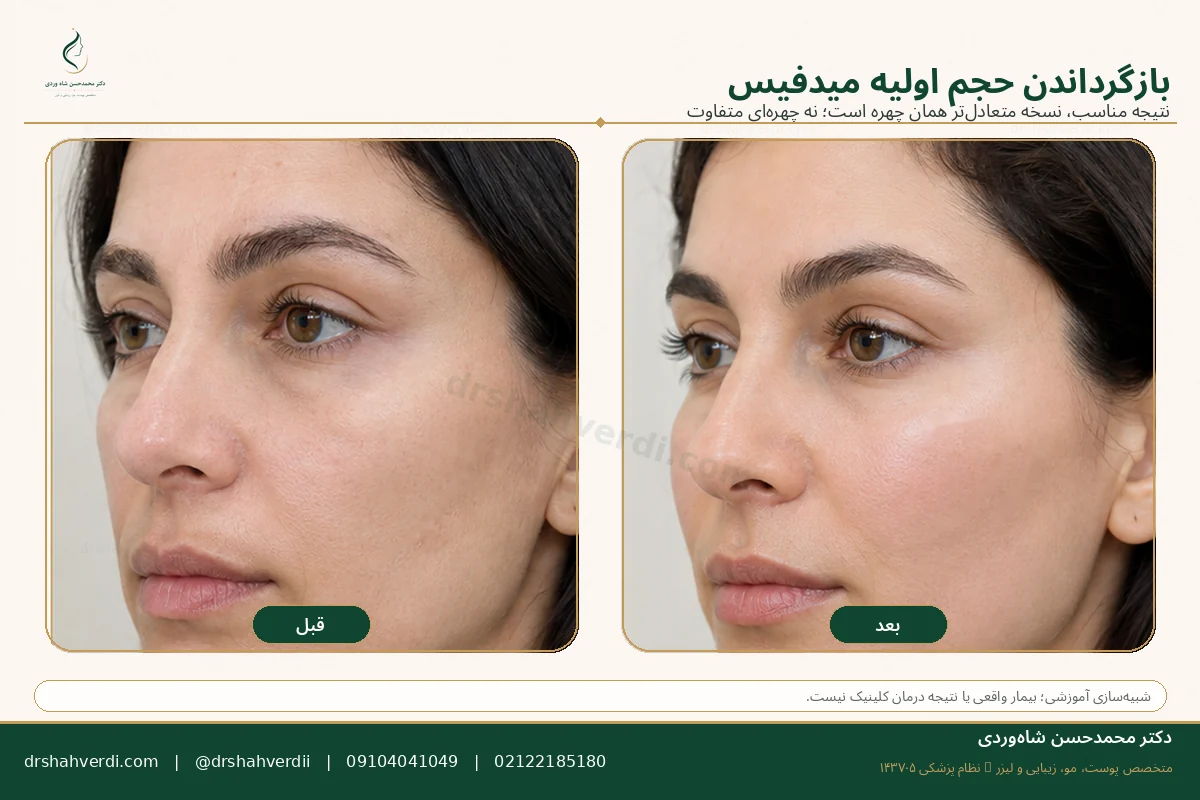 شبیه‌سازی آموزشی فیلر گونه برای کاهش حجم اولیه میدفیس