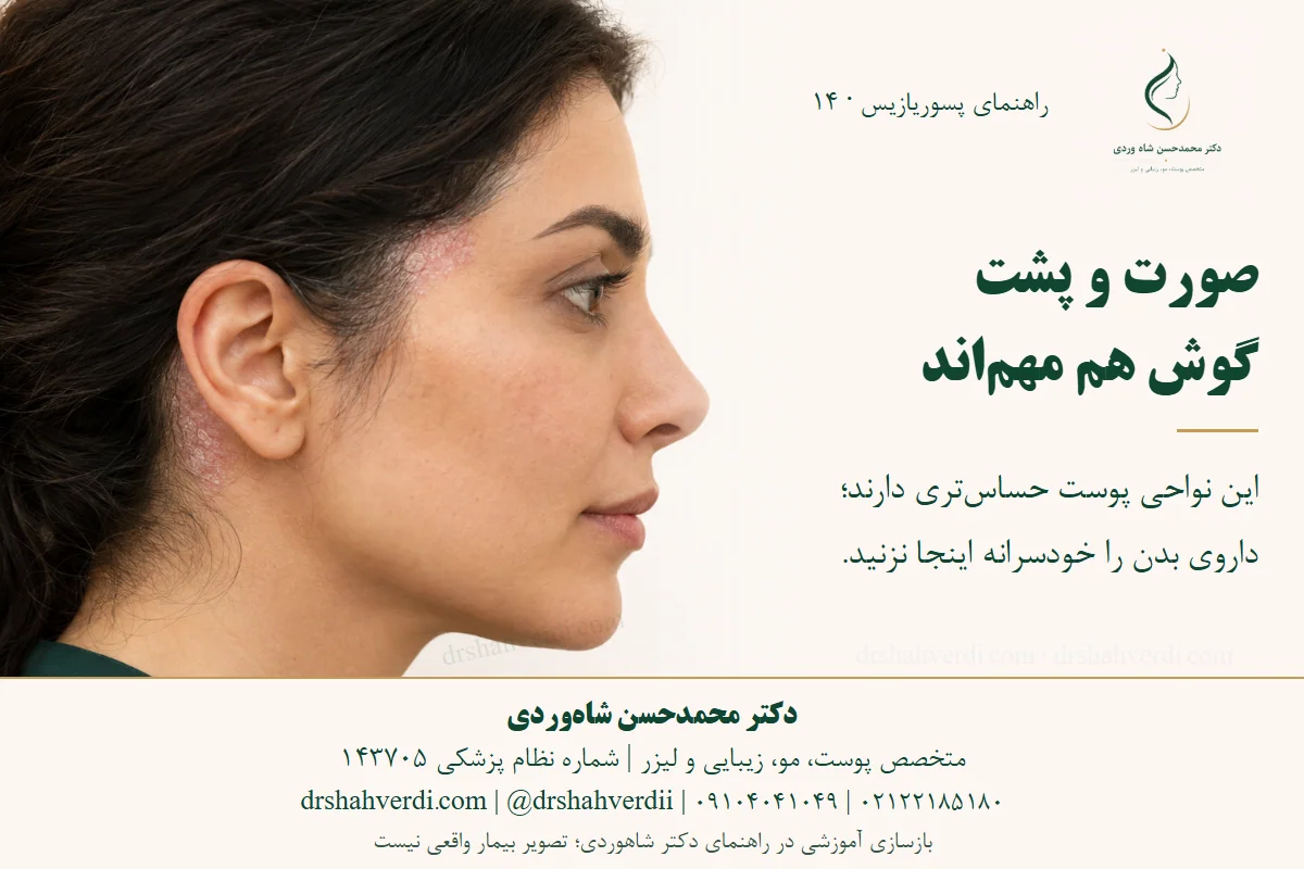 بازسازی آموزشی پسوریازیس خفیف در خط مو و پشت گوش یک زن بزرگسال