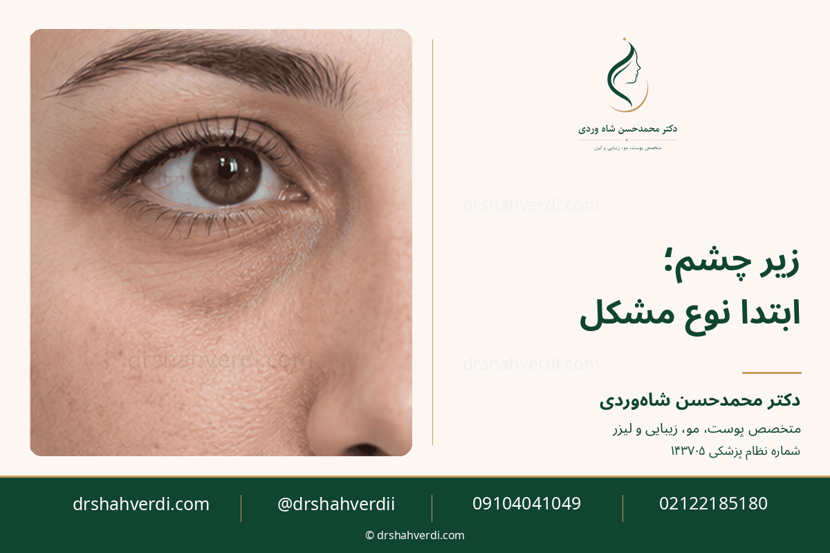گودی زیر چشم و لزوم انتخاب دقیق روش درمان