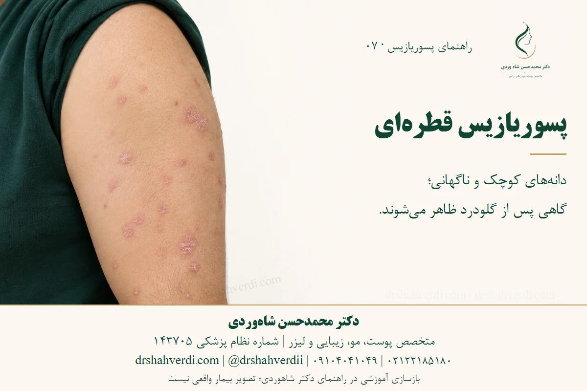 بازسازی آموزشی ضایعات کوچک قطره‌ای و پوسته‌دار پسوریازیس روی بازوی یک بزرگسال