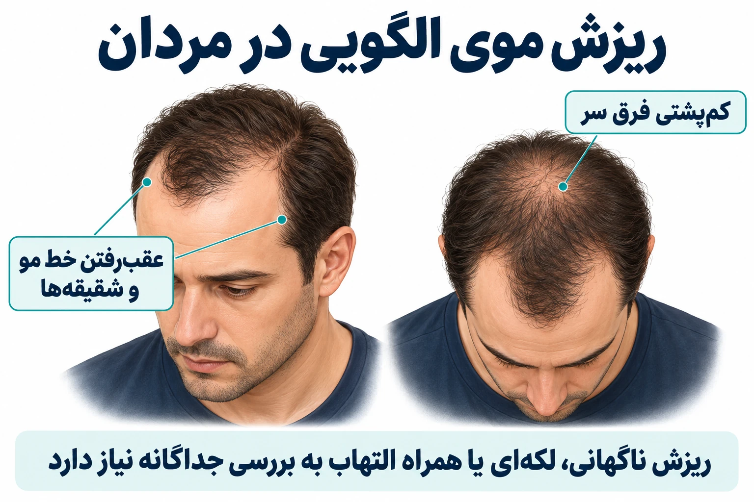 تصویر آموزشی ریزش موی الگویی مردان در دو نما: عقب‌رفتن خط مو و شقیقه‌ها و کم‌پشتی تاج سر