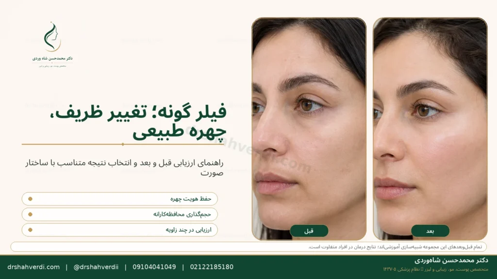 تصویر مقاله فیلر و ژل گونه؛ حجم‌دهی، ماندگاری و نتیجه طبیعی
