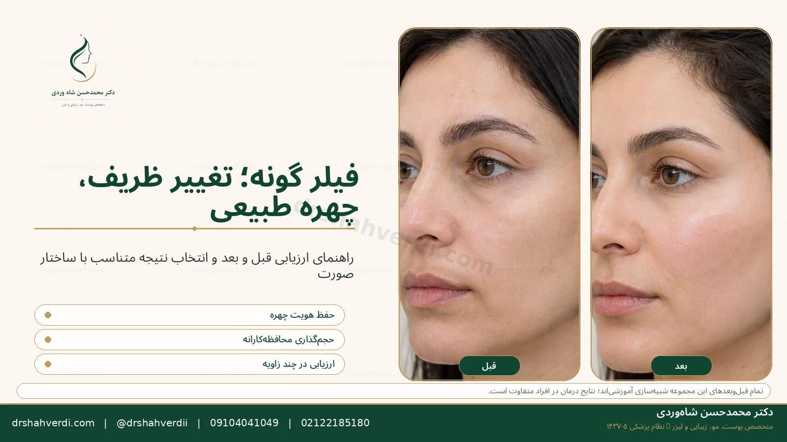 فیلر گونه طبیعی و راهنمای قبل و بعد آموزشی توسط دکتر شاه‌وردی