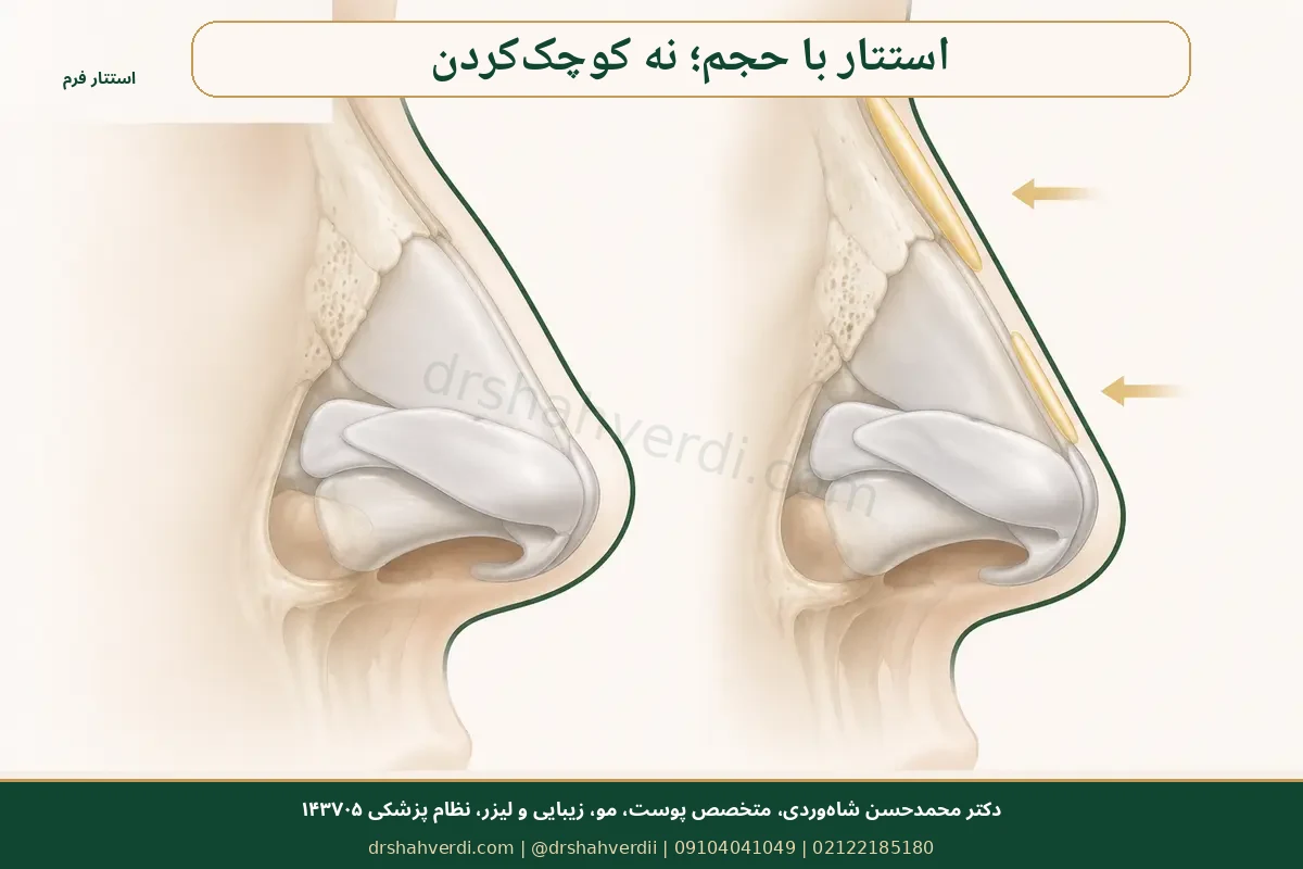فیلر بینی برای استتار قوز خفیف است و بینی را کوچک نمی‌کند