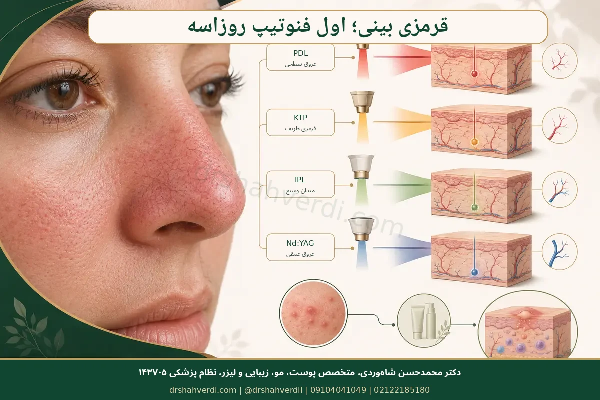 مسیر ارزیابی روزاسه بینی و انتخاب لیزر عروقی