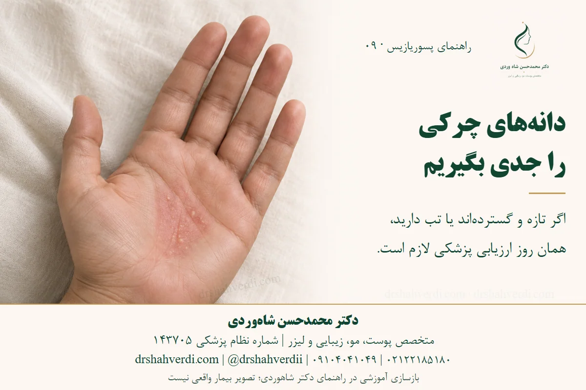بازسازی آموزشی تعداد محدودی پوسچول کوچک غیرخونریزی‌دهنده بر زمینه ملتهب کف دست