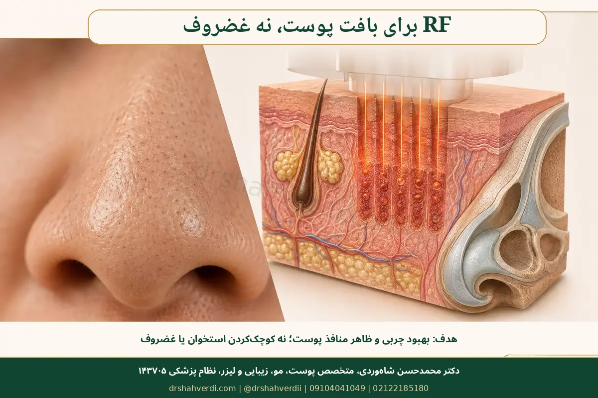 کاربرد محدود RF میکرونیدلینگ برای پوست چرب و منافذ بینی