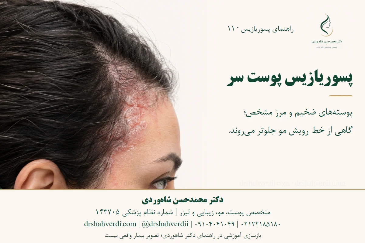 بازسازی آموزشی پلاک پوسته‌دار پوست سر که کمی از خط رویش مو فراتر رفته است