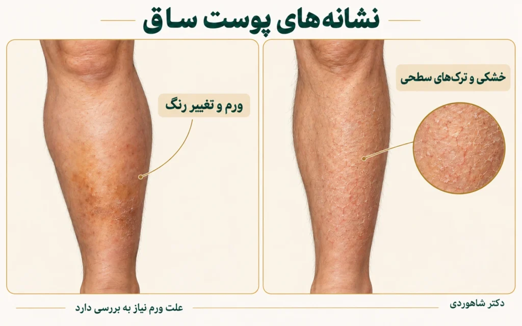 تصویر مقاله خشکی و درماتیت ساق پا؛ ترک‌خوردگی یا مشکل وریدی؟