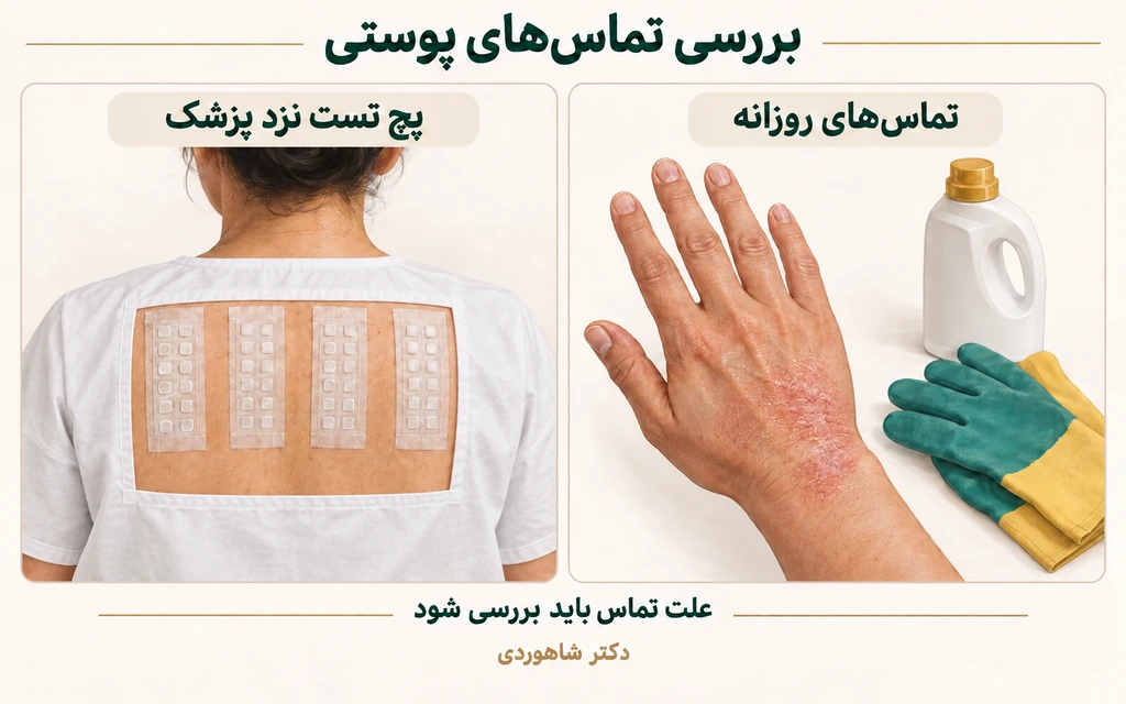 تصویر مقاله درماتیت تماسی؛ تفاوت حساسیت آلرژیک و التهاب تحریکی پوست