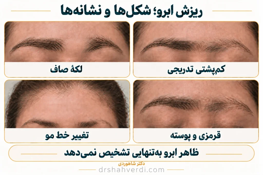 تصویر مقاله ریزش ابرو؛ علتها، بیماریهای مرتبط و درمان