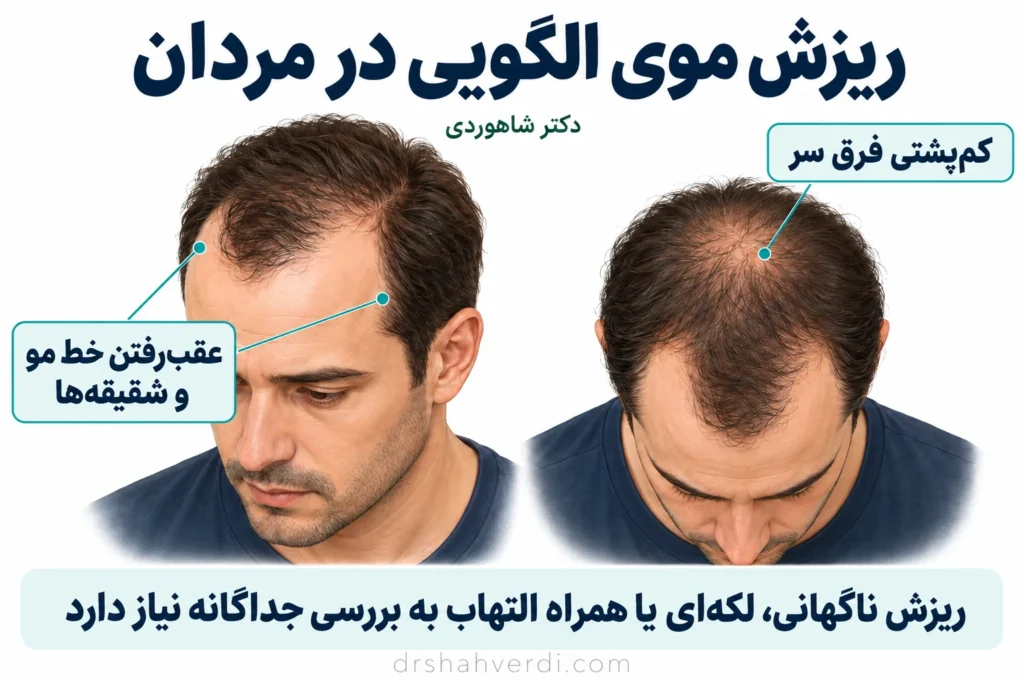تصویر مقاله ریزش مو در مردان؛ علت‌ها و درمان ریزش موی الگوی مردانه