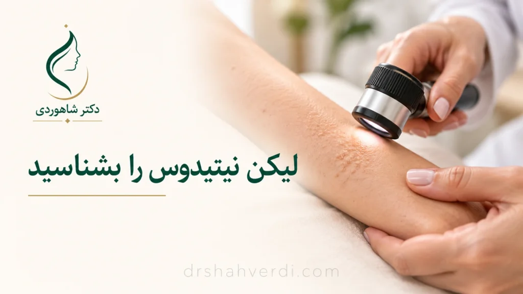 تصویر مقاله لیکن نیتیدوس چیست؟