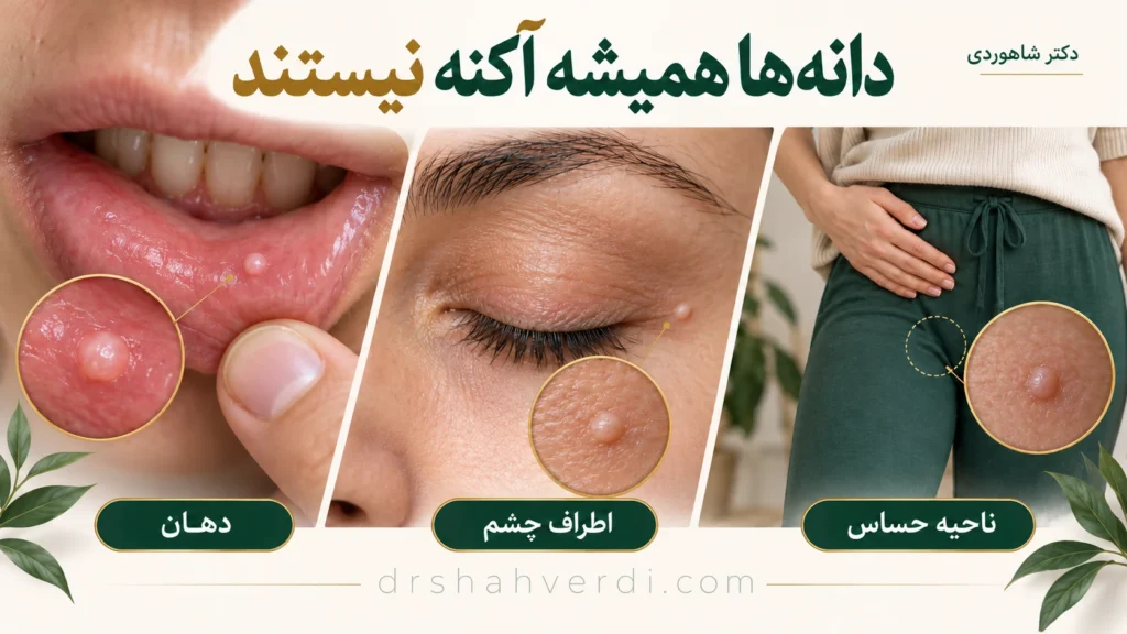 تصویر مقاله دانه شبیه جوش در دهان، اطراف چشم یا ناحیه تناسلی؛ راهنمای مراجعه
