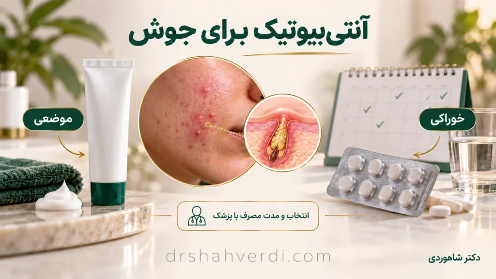 تصویر مقاله آنتی‌بیوتیک برای جوش؛ چه زمانی لازم است و چرا مصرف خودسرانه مناسب نیست؟