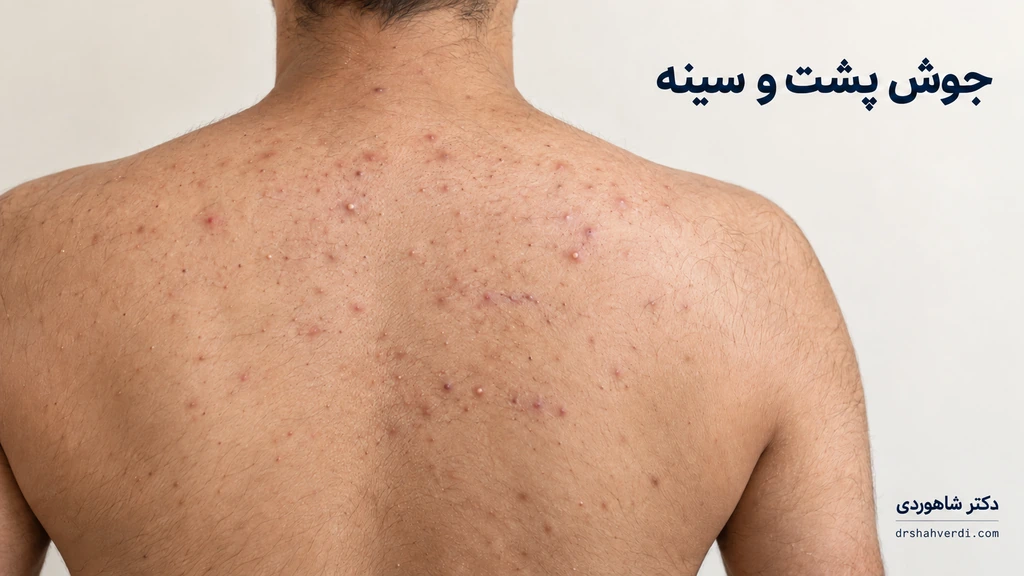 تصویر مقاله جوش پشت، سینه و شانه؛ آکنه بدن یا دانه‌های مشابه؟