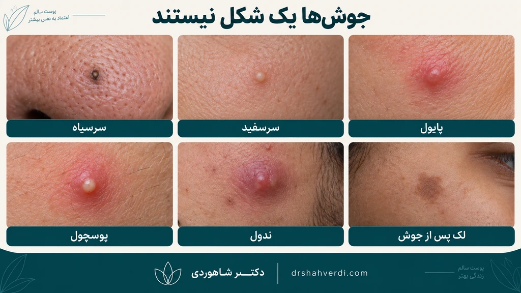 تصویر مقاله داروهای موضعی آکنه؛ بنزوئیل پراکسید، رتینوئید و آزلائیک اسید