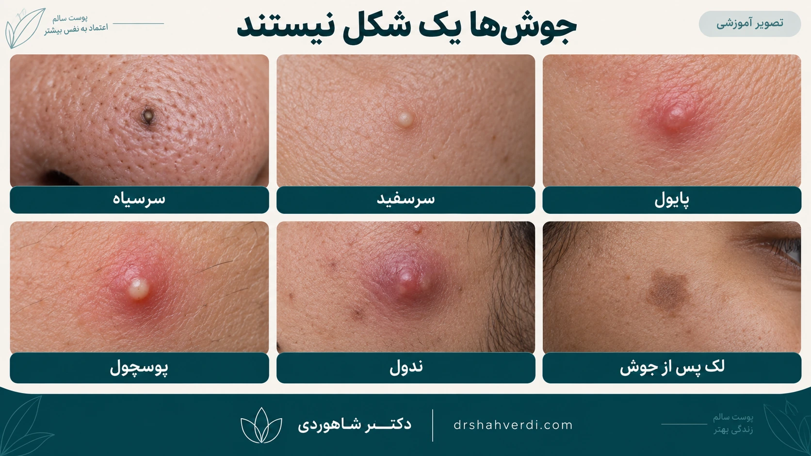 تصویر آموزشی شش شکل ضایعه شامل سرسیاه، سرسفید، جوش قرمز، چرکی، عمقی و لک صاف پس از التهاب