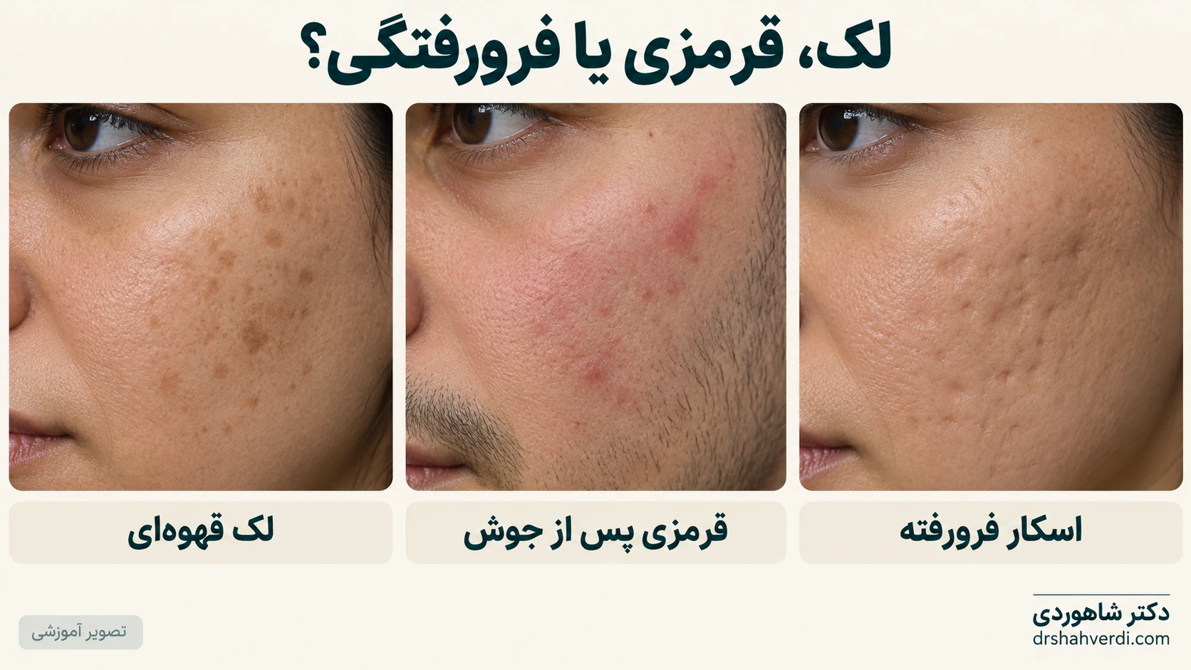 تصویر آموزشی مقایسه لک قهوه‌ای صاف، قرمزی صاف پس از جوش و فرورفتگی اسکار