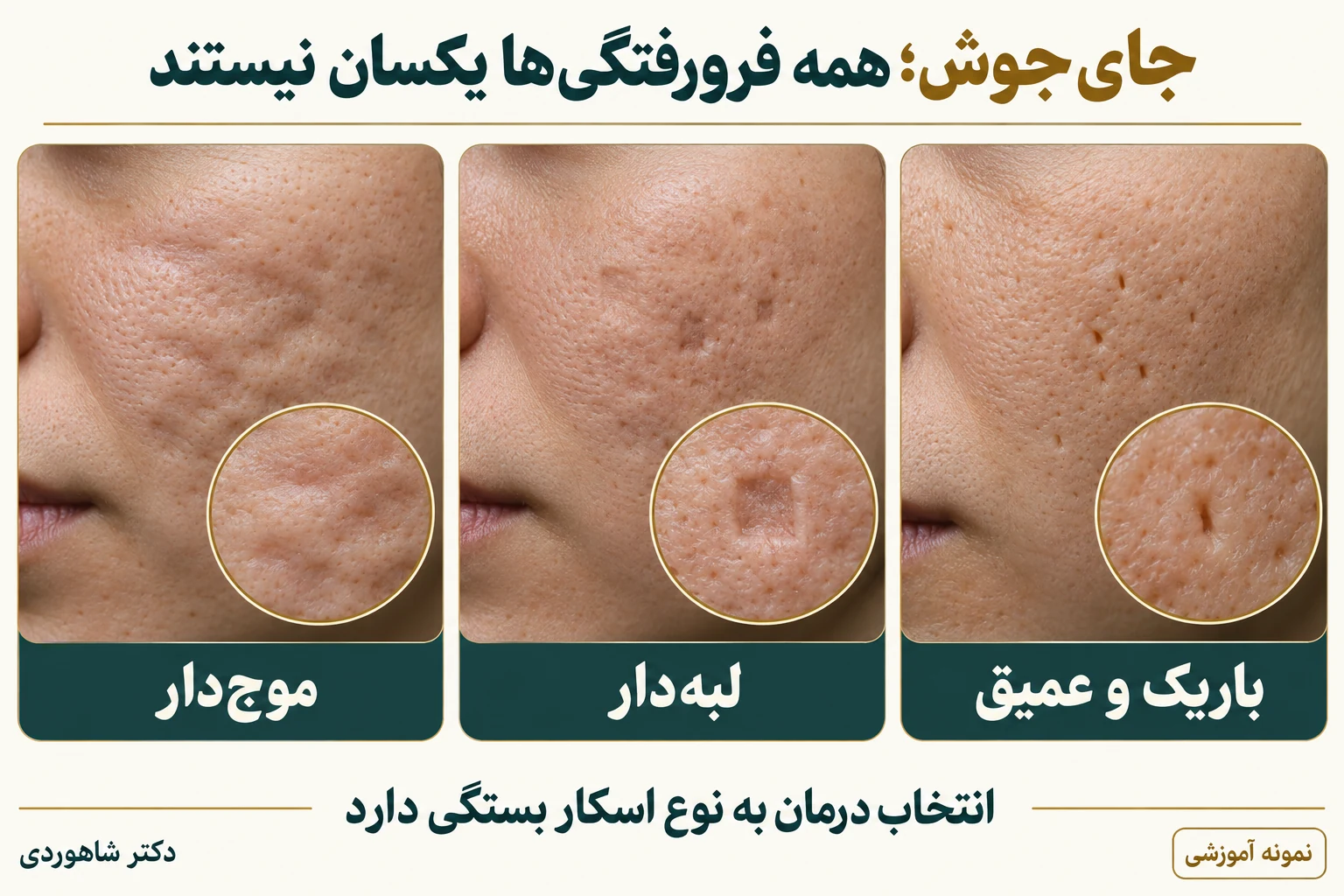 سه نمونه اسکار موج‌دار، لبه‌دار و باریک و عمیق روی گونه
