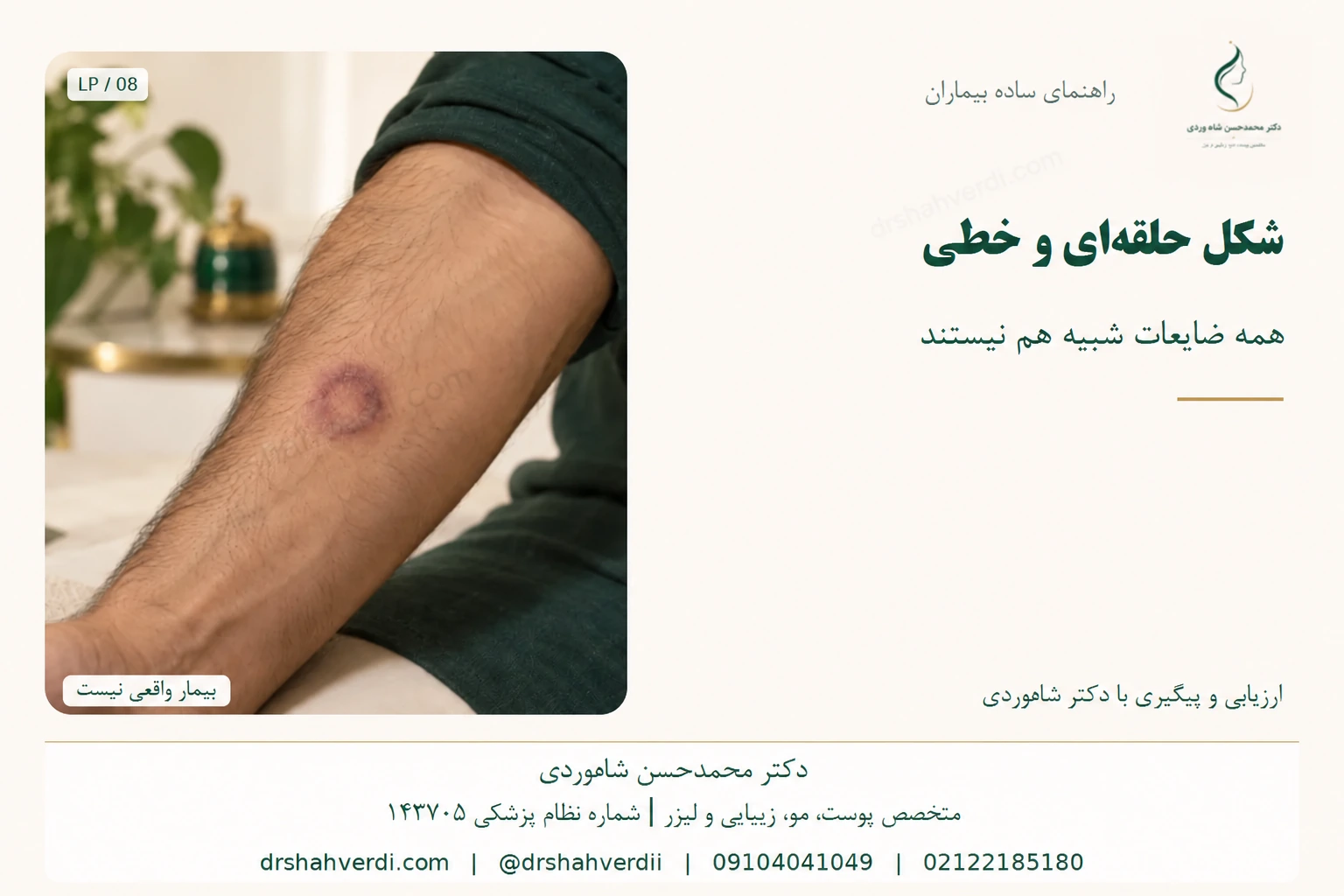 ضایعات پوستی با حاشیه حلقهای در یکی از الگوهای لیکن پلان