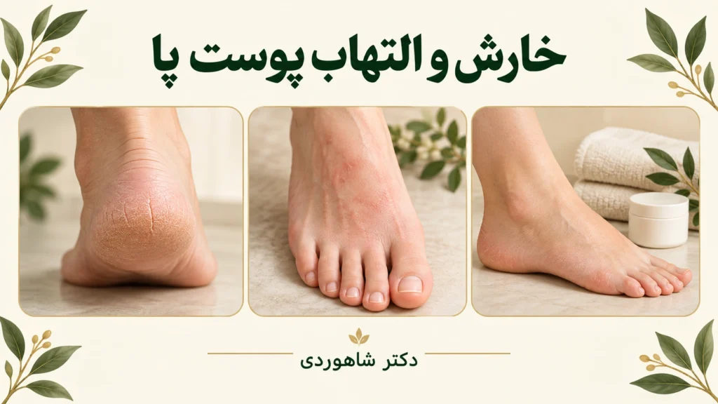 تصویر مقاله اگزما و پوسته‌ریزی پا؛ کف پا و روی پا