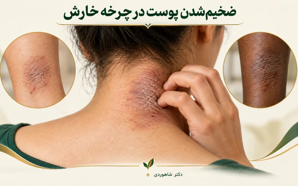 تصویر مقاله لیکن سیمپلکس مزمن؛ خارش و ضخیم‌شدن پوست